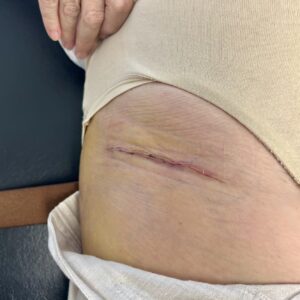 Bikini hip replacement scar 2 weeks