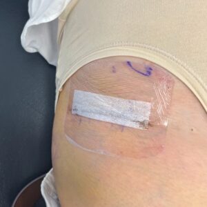 Bikini Incision 2 Week Dressing