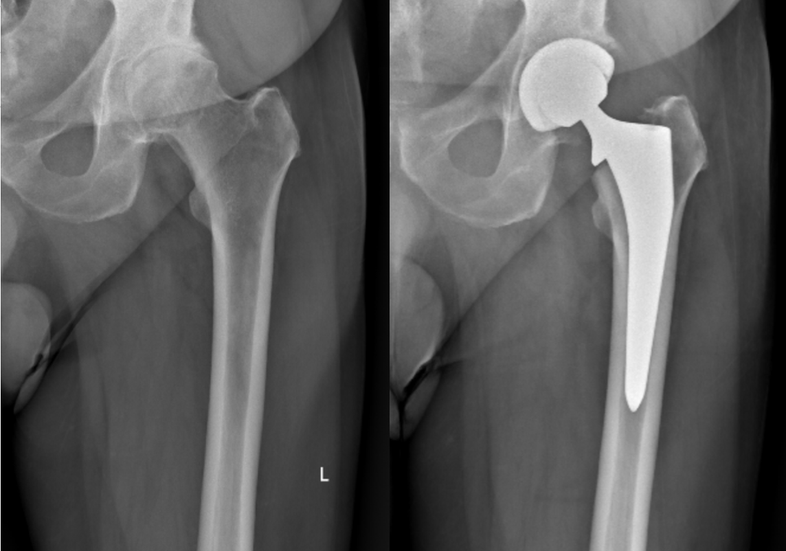 Total hip replacement x-ray