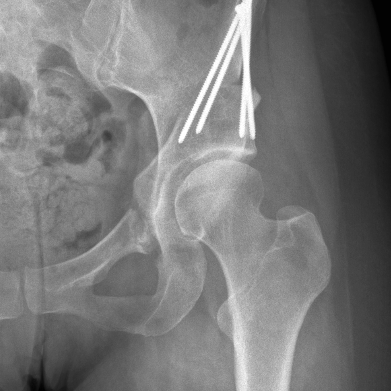 PAO Periacetabular osteoyomy