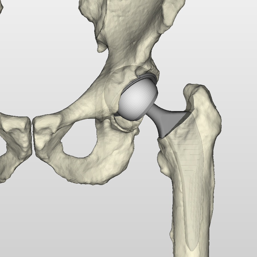 Total hip replacement Sydney