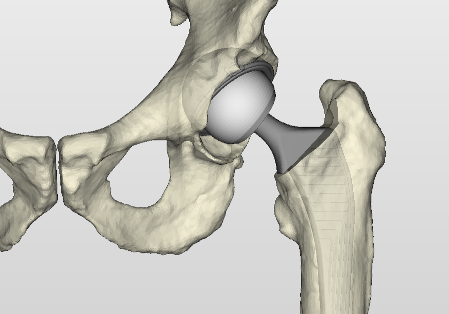 Total hip replacement Sydney