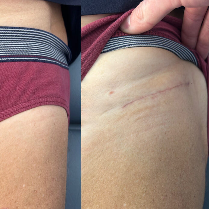 Bikini incision hip replacement scar