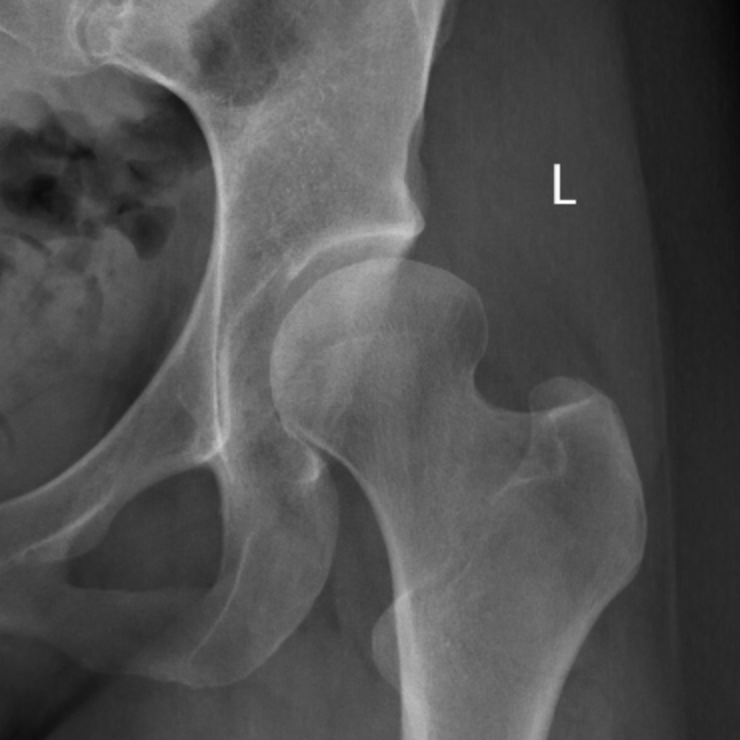 Dysplastic hip